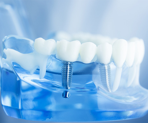 インプラント・再生療法